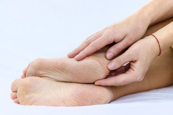 Bàn chân chai sần, dấu hiệu lão hóa da 